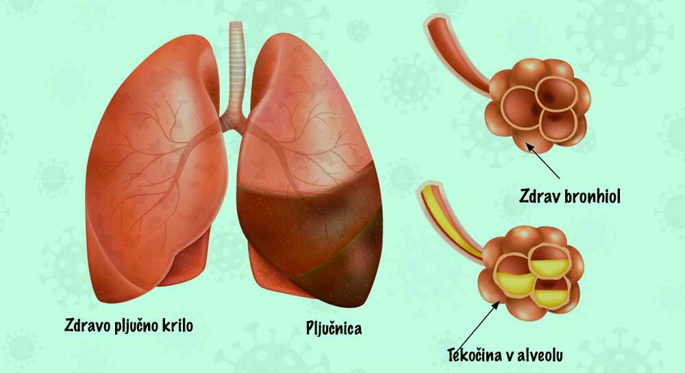 pljučnica-izgled-pljuč
